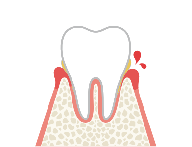 歯肉炎（初期）