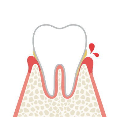 歯肉炎