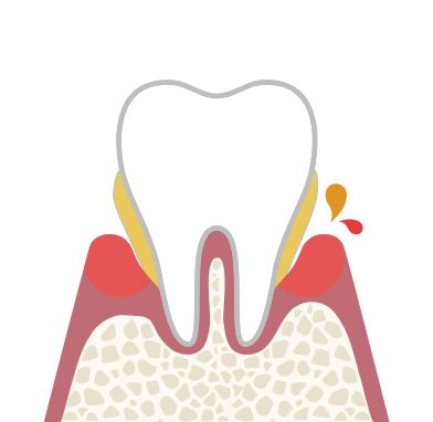 歯周炎