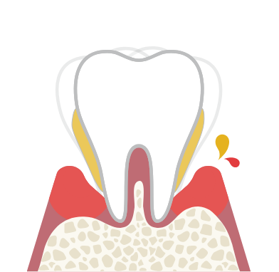 歯槽膿漏